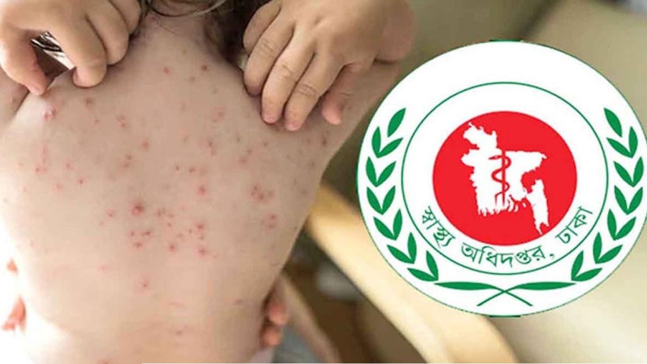 হাম পরিস্থিতি আরও উদ্বেগজনক, একদিনে মৃত্যু ৬